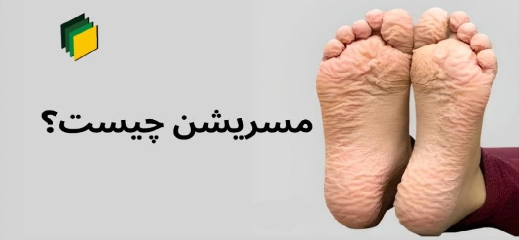 مسریشن زخم چیست؟