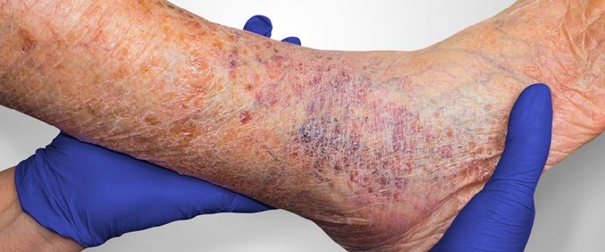 زخم وریدی پا