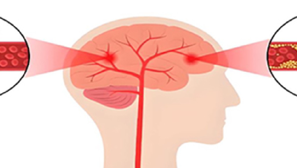 داروهای ضد بارداری خوراکی و سکته مغزی: دوست یا دشمن؟!
