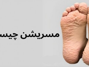 مسریشن زخم چیست؟