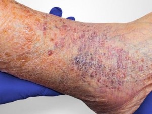 زخم وریدی پا