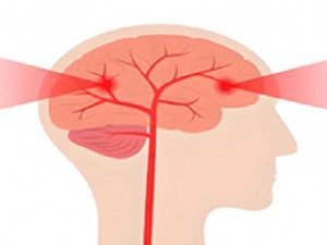 داروهای ضد بارداری خوراکی و سکته مغزی: دوست یا دشمن؟!