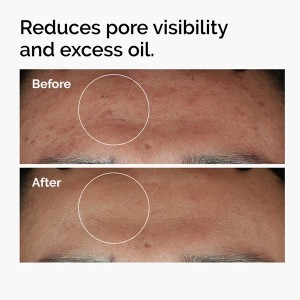 سرم ضدجوش و کنترل‌کننده چربی حاوی نیاسینامید 10% و زینک 1% اوردینری مدل Niacinamide  حجم 30 میل