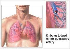 آمبولی ریوی چیست و چگونه درمان می شود؟