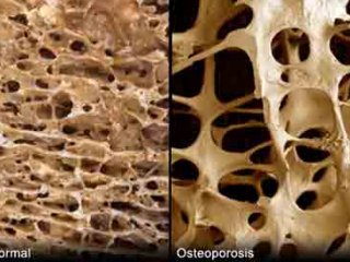 چرا استخوان‌های ما تو خالی می‌شود؟