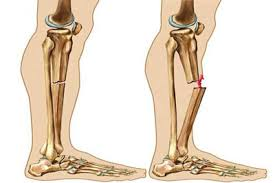 علائم شکستگی استخوان و راههای درمان