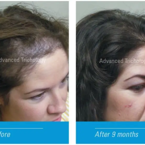 کپسول ضد ریزش مو DHT Blocker برند advance trichology ساخت آمریکا ۱۲۰ عددی