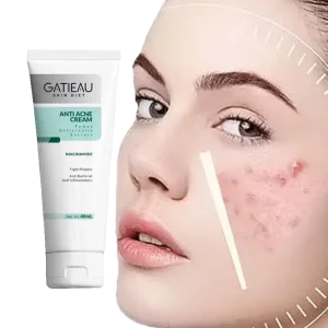 کرم ژل آکنه(ضد جوش و از بین بردن جای جوش ) گاتیو