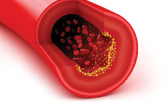 توصیه‌های لازم تغذیه‌ای برای پرفشاری خون با دلایل علمی