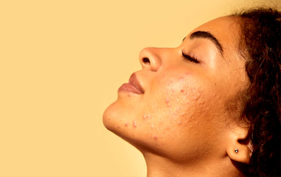 چگونه از پوست چرب مراقبت کنیم؟