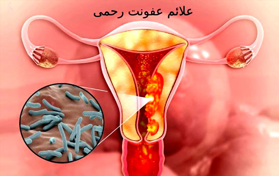 مخاطرات عفونت واژن در زنان و راه درمان