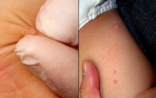 تفاوت زگیل تناسلی و زائده های پوستی