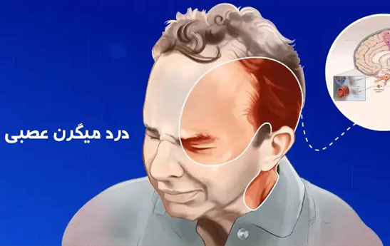 درمان میگرن عصبی