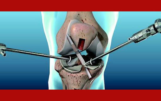 علل و علائم پارگی رباط صلیبی