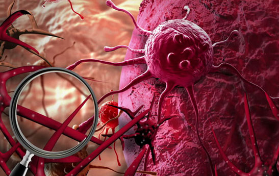 همه چیز پیرامون سرطان خطرناک لنفوم پوستی