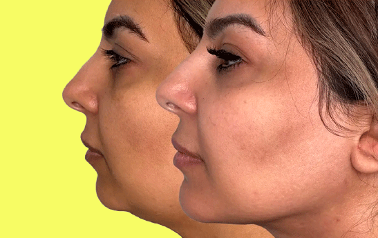 سایه روشن های رفع غبغب با مزوتراپی