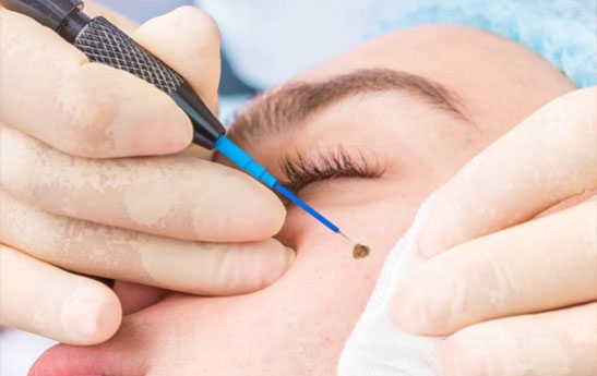 برداشتن خال با لیزر