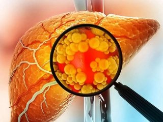 راهکارهای طلایی برای جلوگیری از کبد چرب