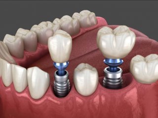 راهنمای جامع برای تصمیم‌گیری درست در مورد متخصص ایمپلنت