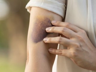 اختلال نادری که پشت کبودی‌های شما پنهان شده