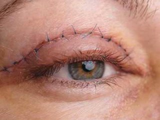 جراحی پلک در این کشورها محبوب است ؛ وضعیت ایران چه‌طور است؟