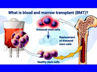 دانستنی‌های مهم پيرامون پيوند مغز استخوان