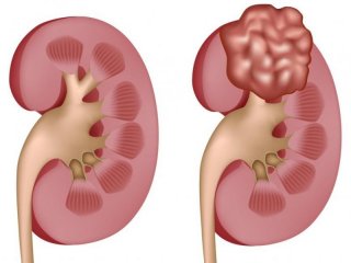 از تومور کلیه چه می دانيد