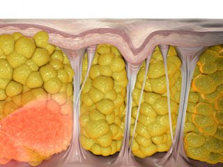 سلولیت چیست و چگونگی ایجاد آن (1)