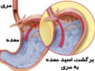 آيا شما هم ترش مي كنيد؟