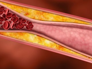 توصیه های مفید برای درمان آترواسكلروز