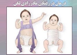 دررفتگی مادرزادی لگن