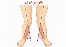 پای ضربدری و پرانتزی در كودكان