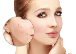تمام نکات مربوط به جوش از دیدگاه طب سنتی