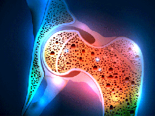 هفت دلیل اصلی ابتلا به  پوکی استخوان