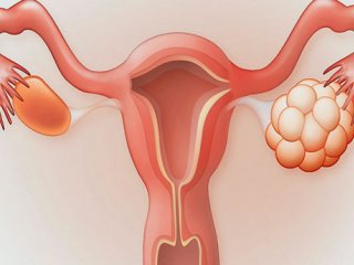 درگیری بانوان ایرانی با سندرم تخمدان پلی کیستیک