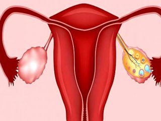 تنبلی تخمدان، از علت تا راه درمان