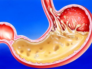 برنامه غذایی که می تواند رفلاکس معده را بهبود ببخشد