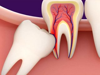 دندان عقل را بکشیم یا نه؟