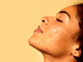 چگونه از پوست چرب مراقبت کنیم؟