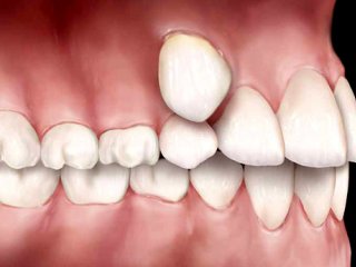 دلایل رویش دندان اضافه فک بالا و پایین