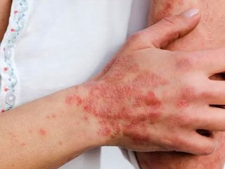 یکی از عوامل ابتلا به بیماری‌های خودایمنی در زنان