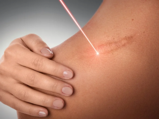 درمان قطعی ترک پوستی در مشهد با لیزر فوتونا | کلینیک شاپرک طلایی