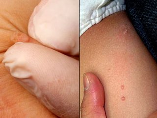 تفاوت زگیل تناسلی و زائده های پوستی