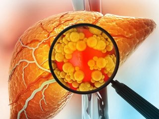 ۲ مقصر اصلی کبد چرب و سیروز کبدی چیست؟