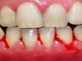 خونریزی لثه در این شرایط نشانه «ایدز» و «سرطان» است
