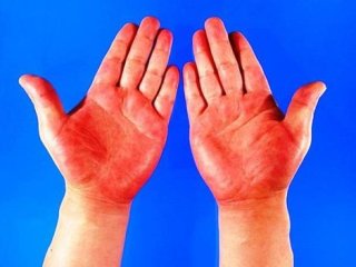 کف دست قرمز نشانه ی چه بیماری است؟