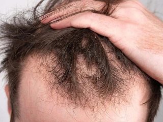 توضیحات مهم درباره عوارض دو داروی ریزش مو