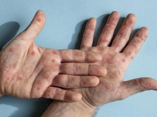 آبله میمونی به ایران رسید؟ علائم را جدی بگیرید