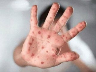 مراقب شیوع ویروس آبله میمونی باشید