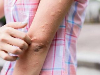 دلایل به وجود آمدن کهیر بر روی پوست چیست؟